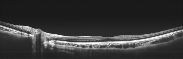 想完成中高端眼科器械的进口替代，「图湃影像」自主研发扫频 OCT 视网膜诊断系统