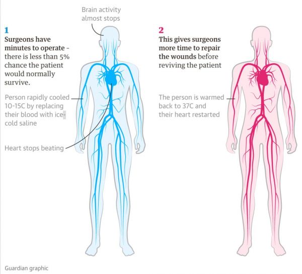 起死回生：美国科学家首次让人类进入“假死状态”，换取手术时间