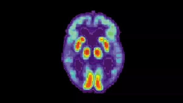 以“阿尔兹海默症”为案例，AI+慢病管理该怎么做？