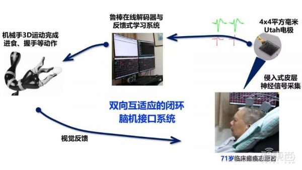 中国首例，大脑植入电极，高位截瘫病人用意念喝水