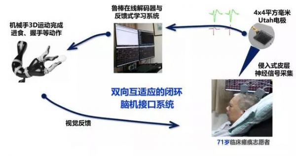 国内首例，浙大“双脑计划”让72岁高位截瘫患者只靠意念喝可乐打麻将