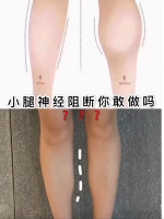 我就是那个为了瘦腿“挑断脚筋”的女生