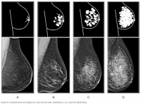乳腺癌筛查新争议:密度过高,该告知吗?