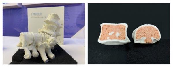3D打印成未来医疗趋势，「博恩生物」研发出可生长发育的人造骨