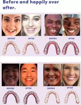 美国远程牙齿矫正独角兽SmileDirectClub将于纳斯达克上市