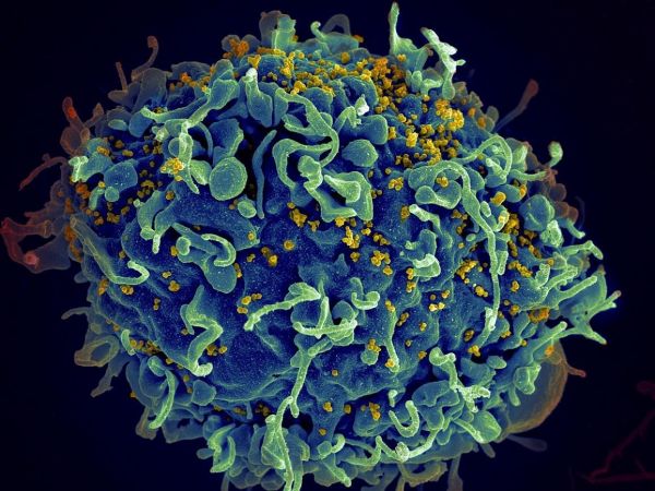基因疗法也许会给HIV病毒感染者带来希望