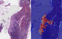 AI 对癌症治疗有什么帮助?