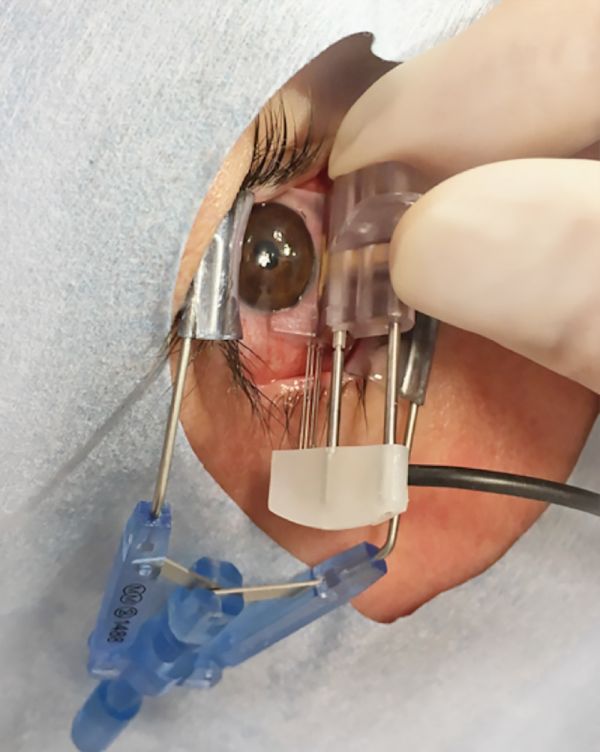 打破眼科疗法的侵入性弊端，「 Eyevensys」开发新型眼科重疾药物