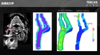 从血液动力学到深度学习，「景三科技 」提供精准斑块脱落风险评估方案