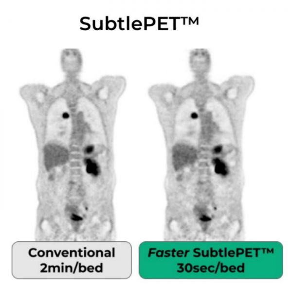 左为常规PET检测影像，右为SubtlePET使PET检测速度提升四倍，同时保证成像质量