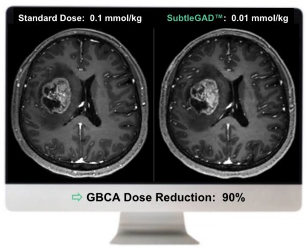 左为常规剂量，右图中SubtleGAD将造影剂剂量降低了90%而不影响影像质量
